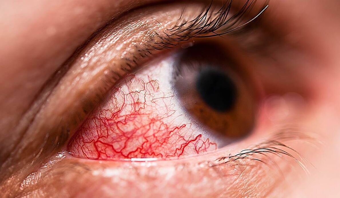 Dijabetička retinopatija jedna je od kasnih komplikacija dijabetesa
